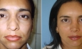 Secondary rhinoplasty (after several previous surgeries by other surgeons)