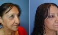 Facelift, forehead lift, rhinoplasty and lips